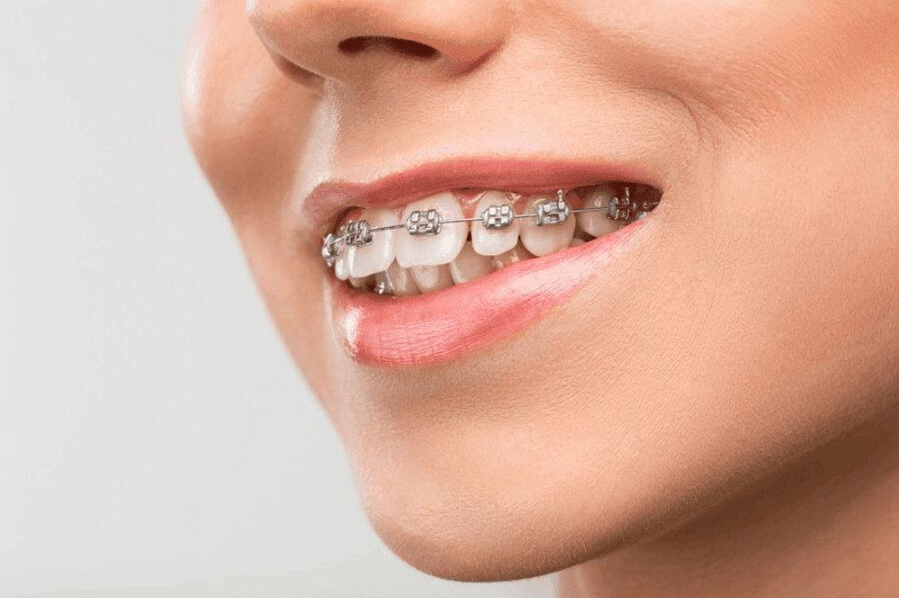 how to care for your invisalign aligners tips for best results